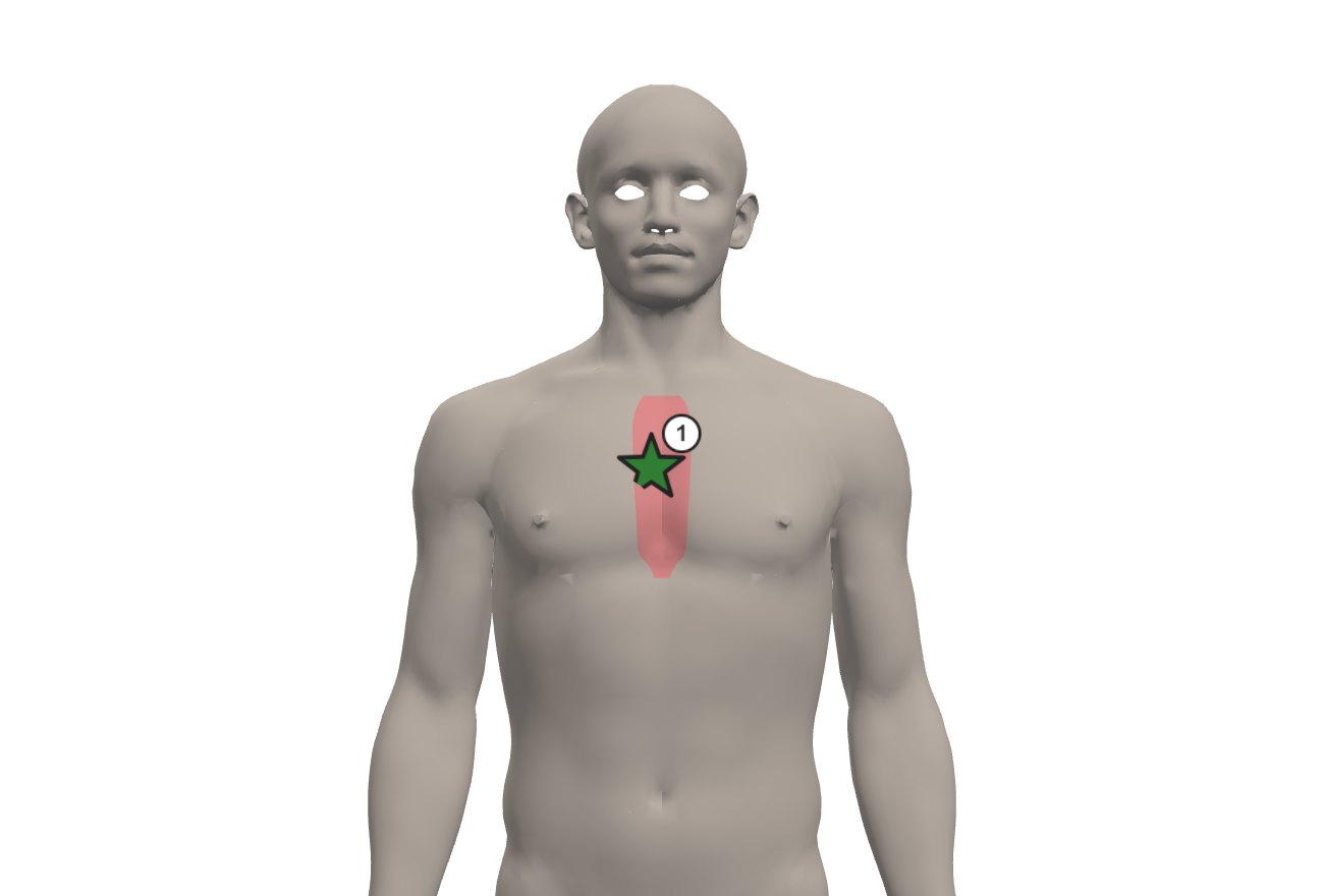 Figura do corpo em 3D com uma lesão contusa marcada na região esternal, como entra no laudo